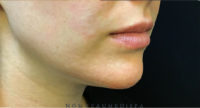 Chin Rejuvenation