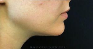 Chin Rejuvenation