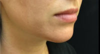 Chin Rejuvenation