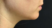 Chin Rejuvenation