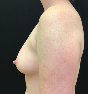 Breast Augmentation