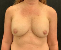 Breast Implant Revision