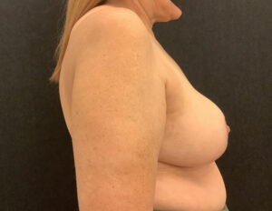 Breast Reduction