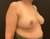 Breast Reduction