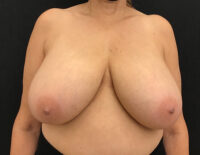 Breast Reduction