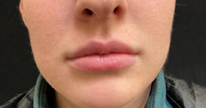 Lip Augmentation