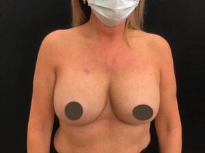 Breast Augmentation