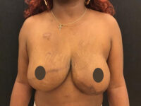 Breast Implant Revision