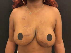 Breast Implant Revision