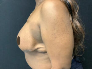 Breast Implant Revision