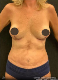 Breast Implant Removal