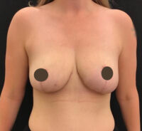 Breast Reduction