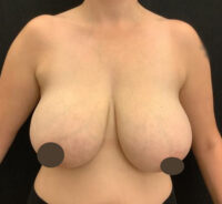 Breast Reduction