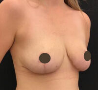 Breast Reduction