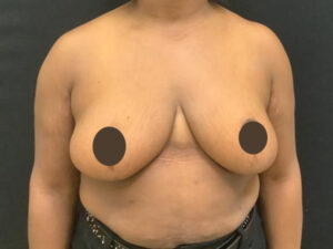 Breast Reduction