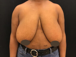 Breast Reduction