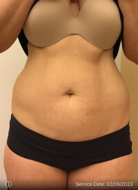 EMSculpt
