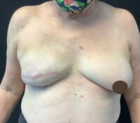 Breast Implant Revision