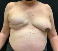 Breast Implant Revision