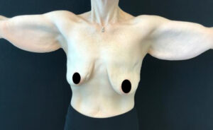 Breast Lift