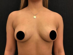 Breast Augmentation