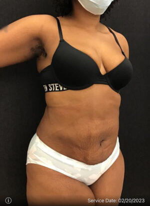 Liposuction