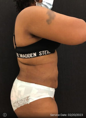 Liposuction