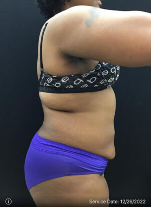 Liposuction