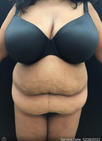 Liposuction