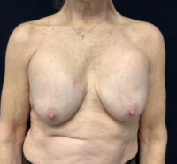 Breast Implant Removal