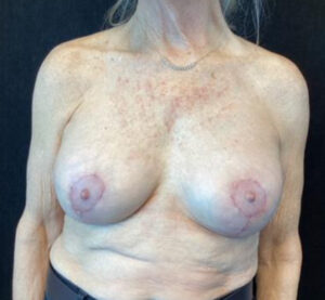 Breast Implant Removal