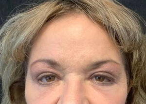 Upper Eyelid Blepharoplasty