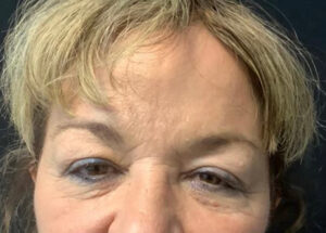 Upper Eyelid Blepharoplasty