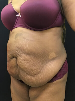 Tummy Tuck