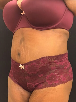 Tummy Tuck