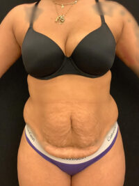 Tummy Tuck