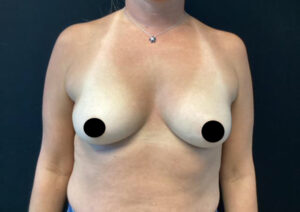 Breast Augmentation