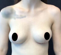 Breast Implant Removal