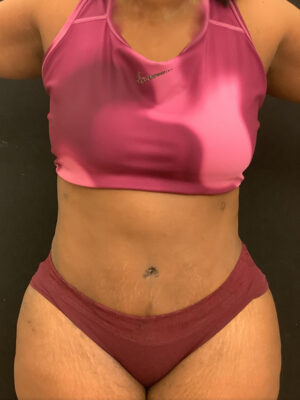 Tummy Tuck