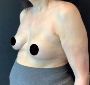 Breast Lift