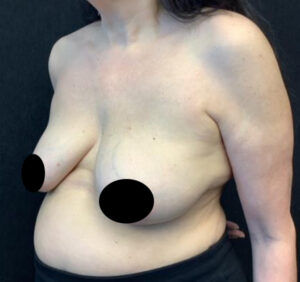 Breast Lift