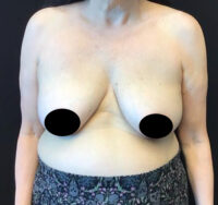 Breast Lift