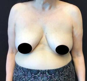 Breast Lift