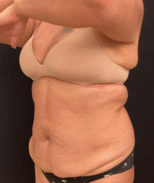 Tummy Tuck