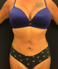 Tummy Tuck