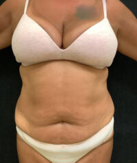 Tummy Tuck