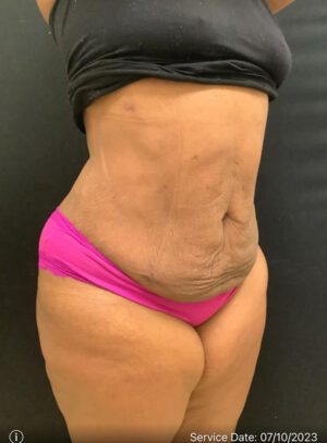 Liposuction