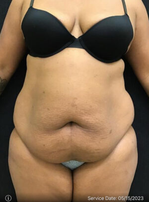 Liposuction