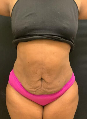 Liposuction