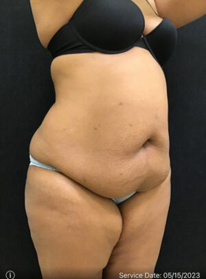 Liposuction